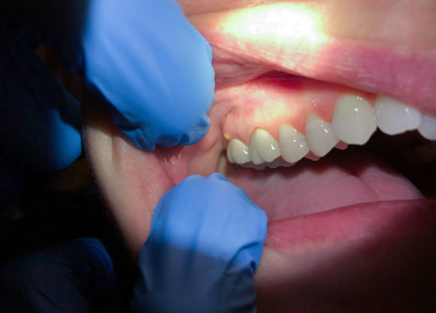 Best Emergency Dental Care for Abscessed Tooth in Laingsburg, MI